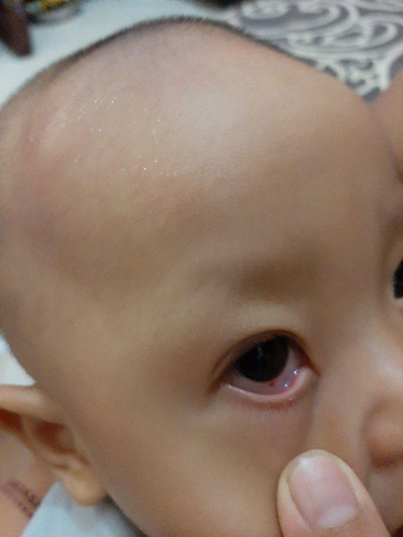 Titik merah di bagian putih mata