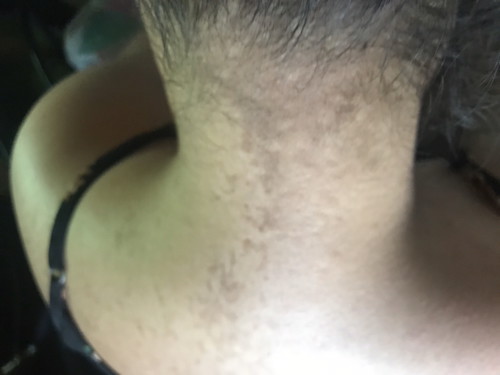 Dark spot