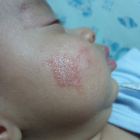 ลูกเป็นผื่นที่หน้าค่ะ