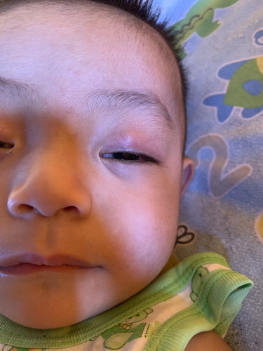 ตาลูกบวมๆ