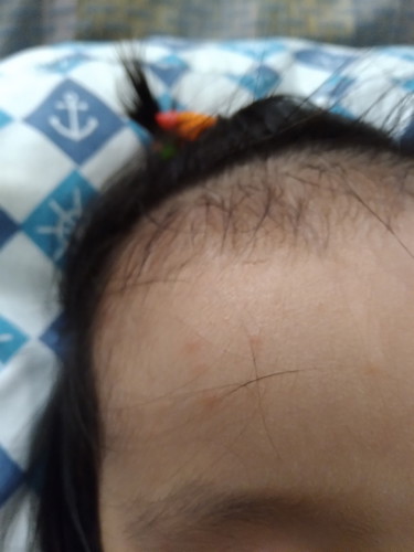 rashes at mga kagat ng lamok