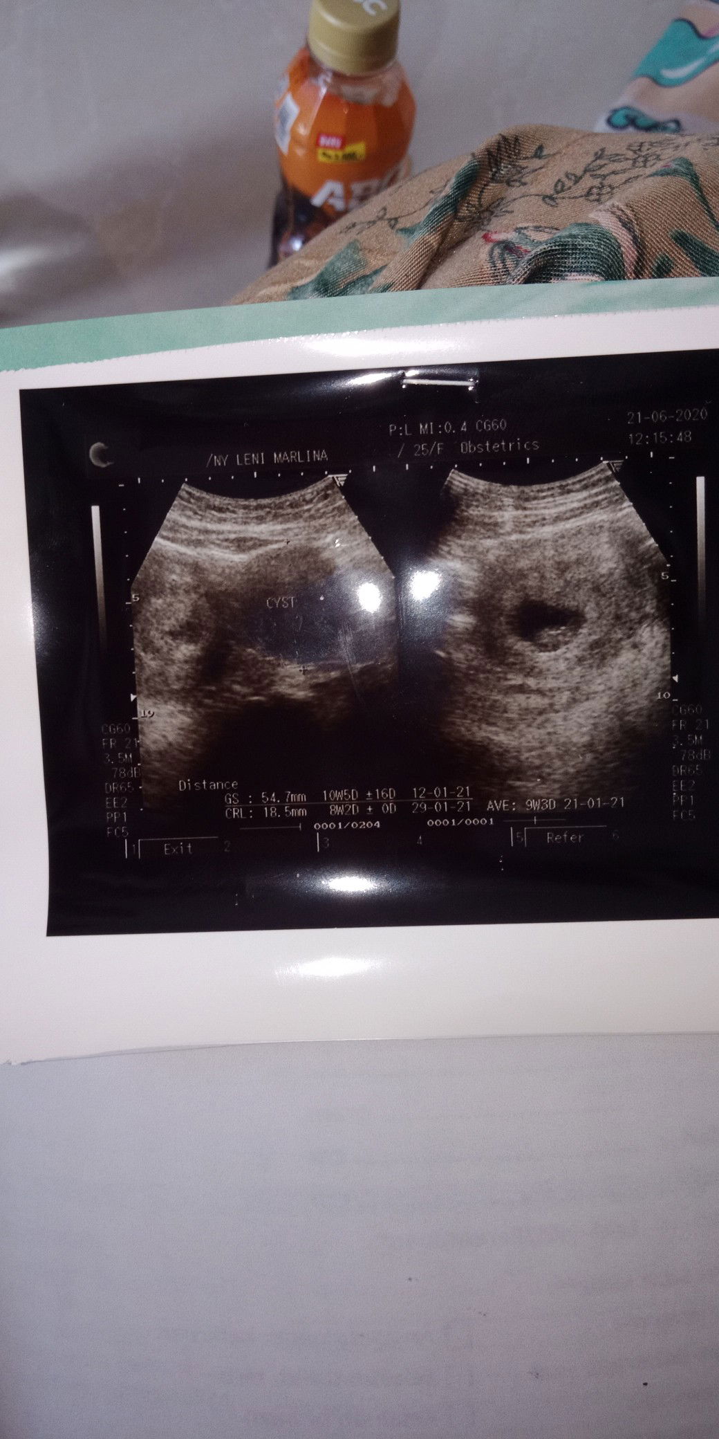 ada kista ovarium di kehamilanku