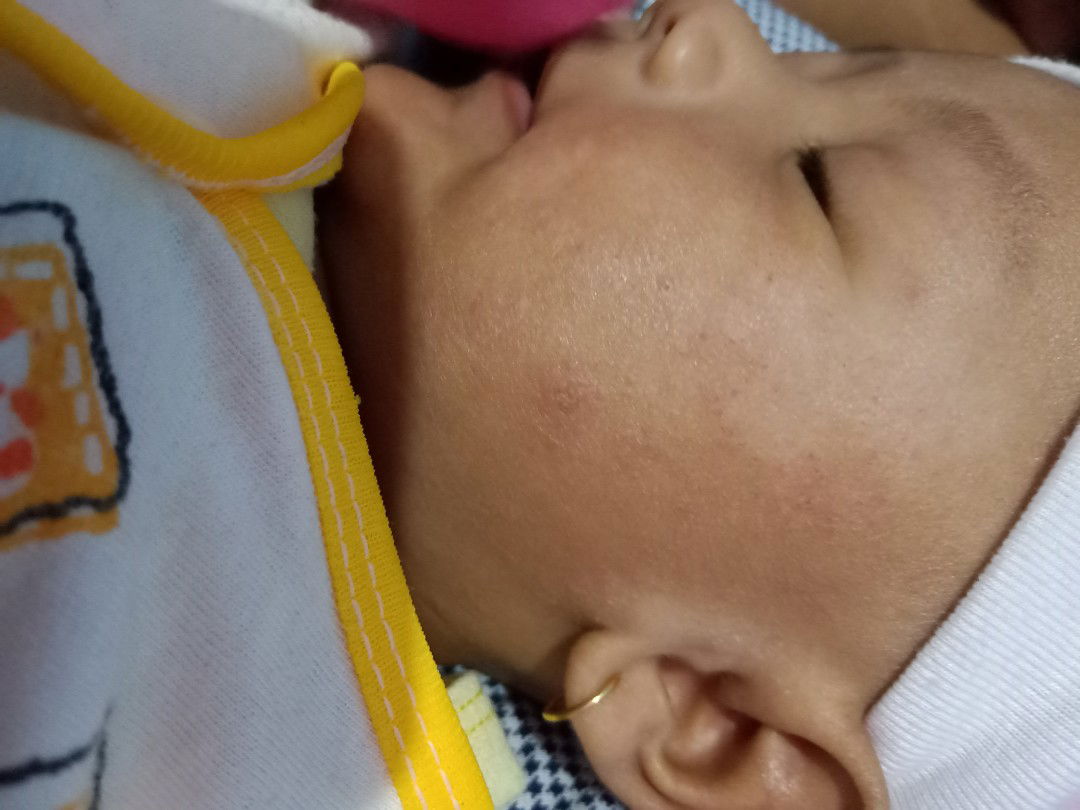 ruam pada wajah bayi