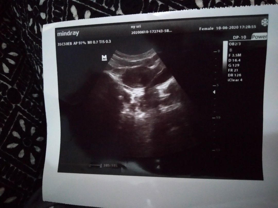USG kehamilan