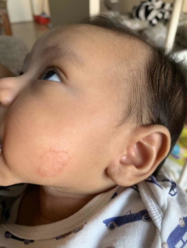 มีแม่ๆท่านไหนที่ลูกเป็นผื่นแบบนี้บ้างค่ะ