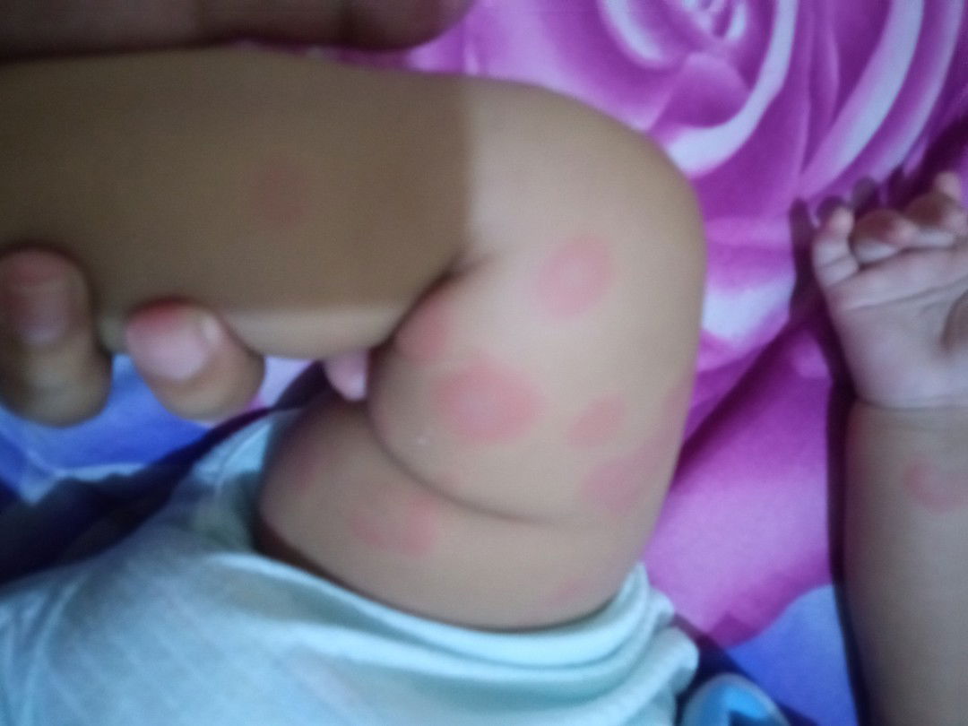 Demam dan muncul ruam merah