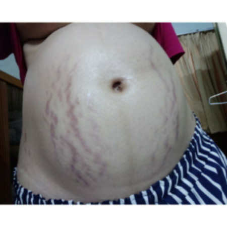 ท้องแตกลาย