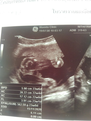 รูปอัลตร้าซาว