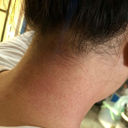 Itchy