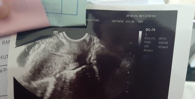 pendarahan kelahamilan 7 minggu