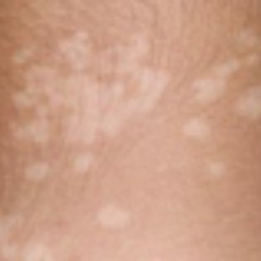 Bercak putih pada bayi