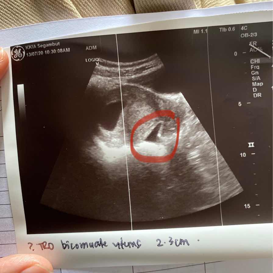 Something not sure sebelah kantung baby