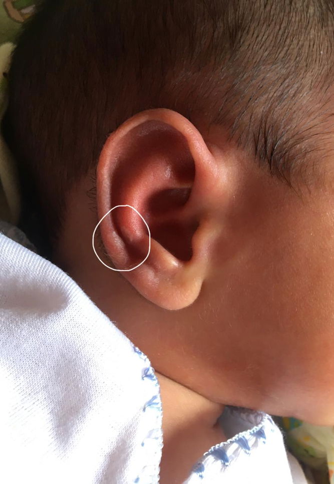 Muncul seperti herpes di telinga