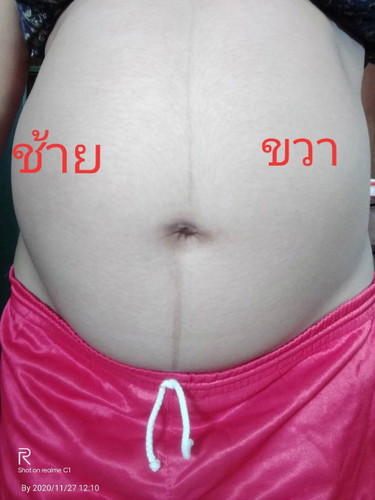 7เดือน32w5d