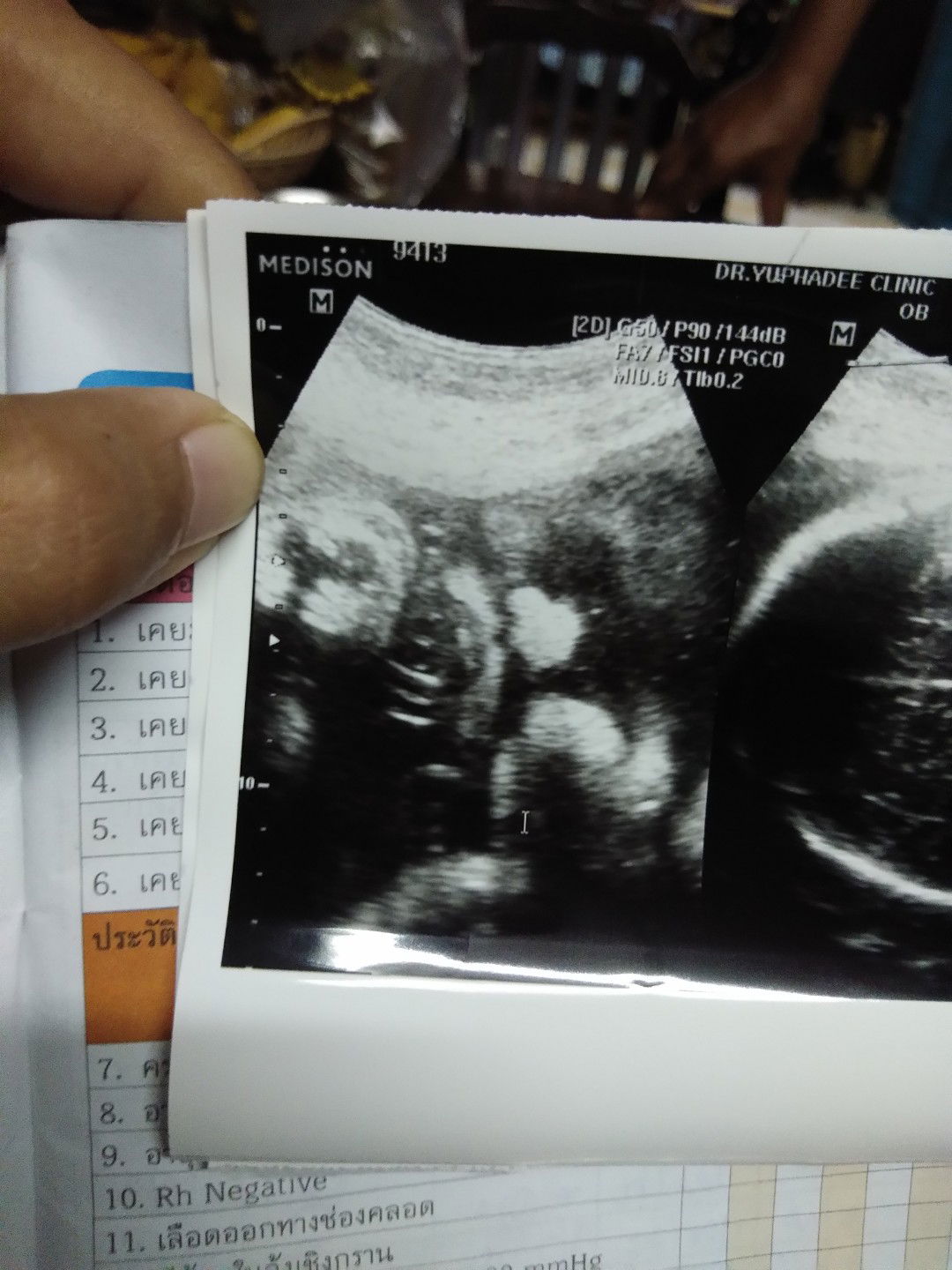 ขอวิธีเร่งคลอดแบบธรรมชาติหน่อยค่ะ?