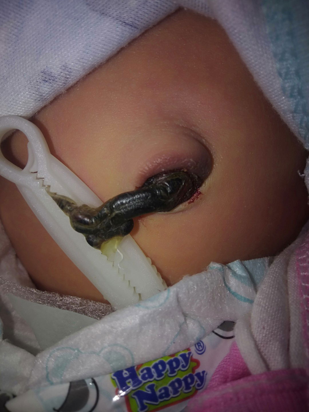 tali pusar bengkak dan berdarah