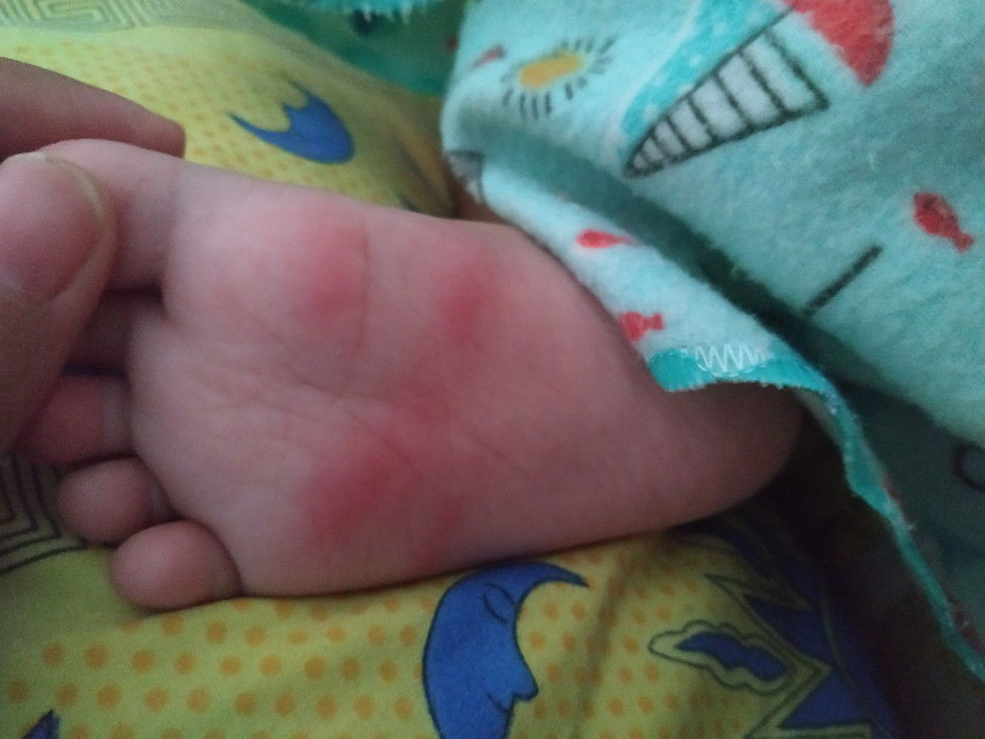 Kaki bayi ku kok merah bentol bentol