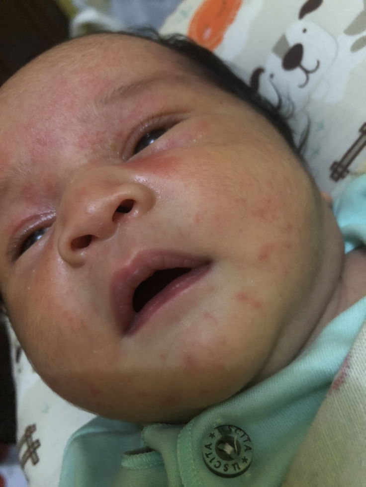 Muncul bintik2 setelah kasih susu formula