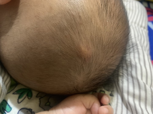 Benjolan merah pada bayi