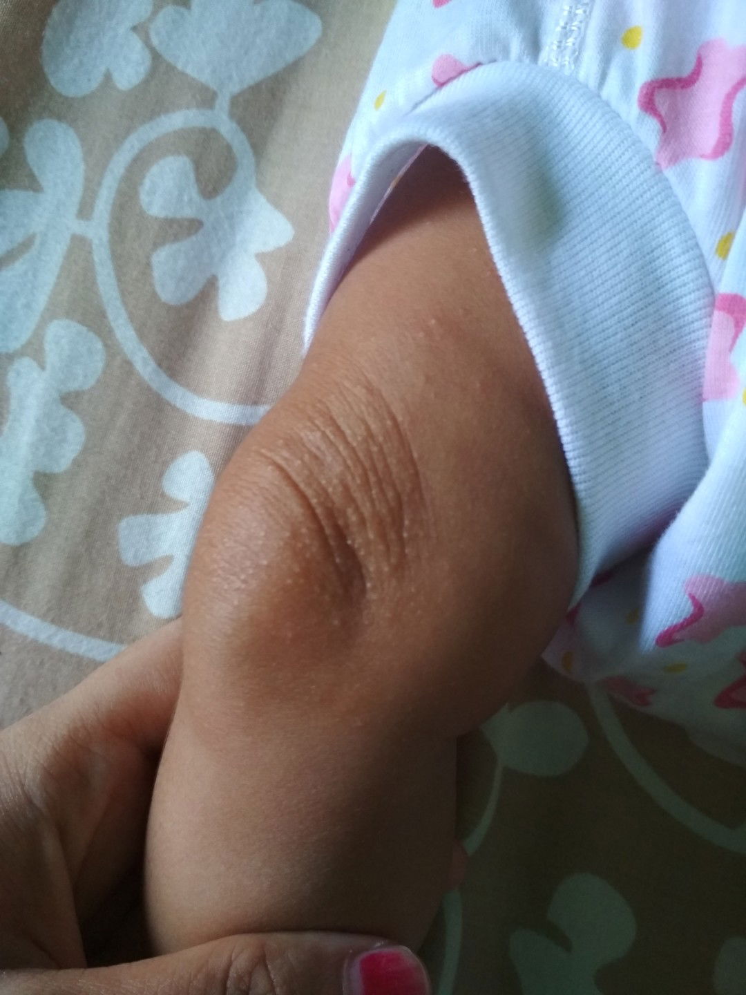 bentol pda lutut bayi