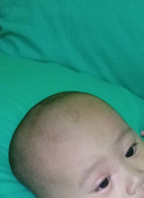 Mata Bengkak tergigit semut