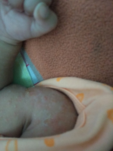 bayi aku masih umur 18 hari tapi ada merah 2 di lengannya itu gatal 2 apa ya?