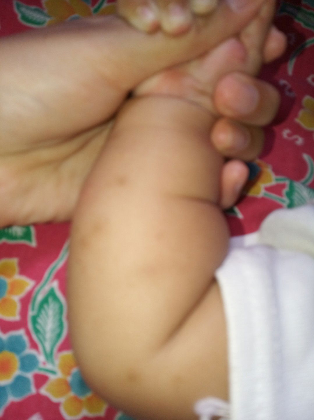 bekas gigitan nyamuk