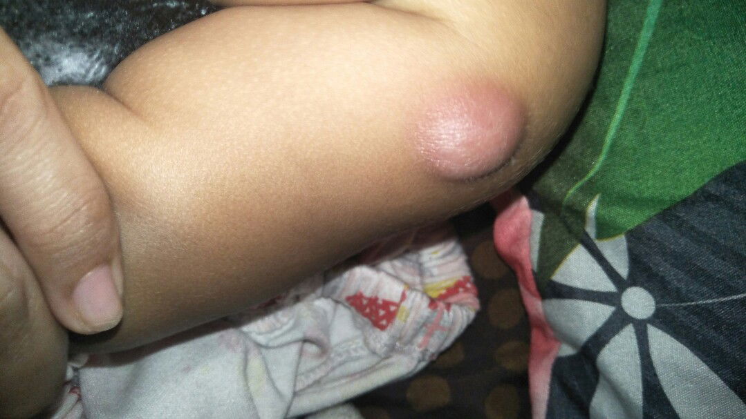 bengkak imunisasi bcg