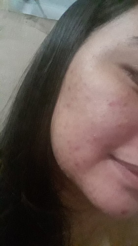 Pimples