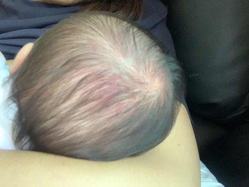 ผื่นที่หน้าและศีรษะ