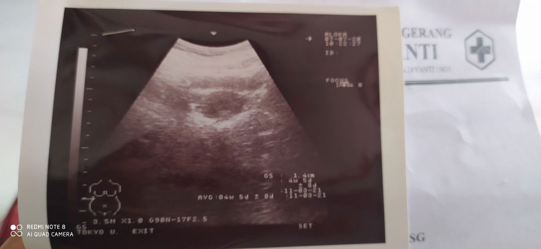 keguguran