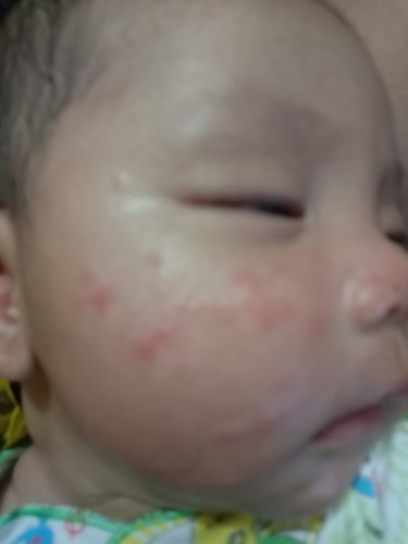 bintik* di muka