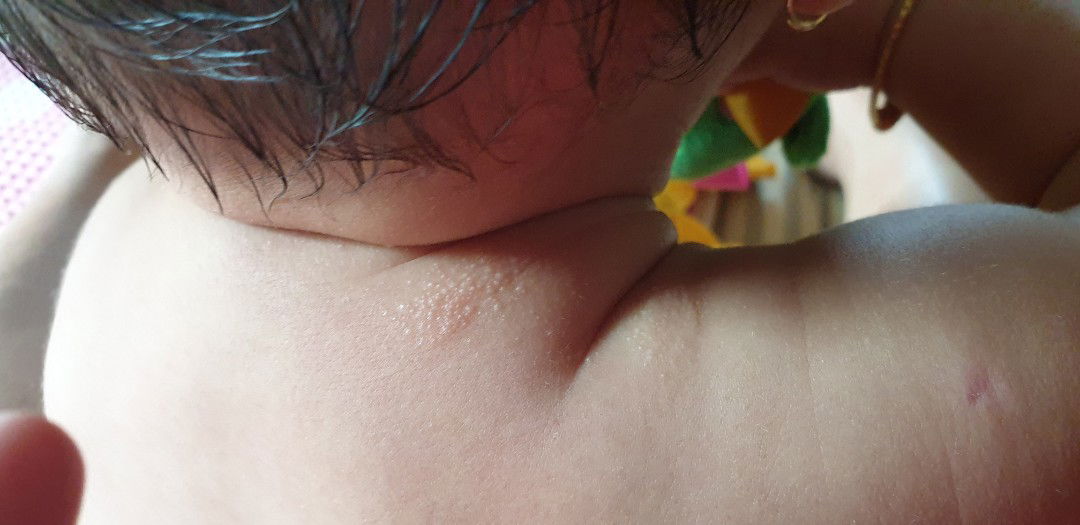 bintik pada badan bayi