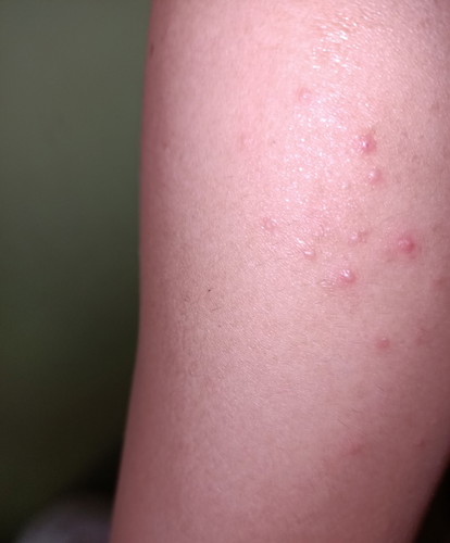pimples. (3M&1week)