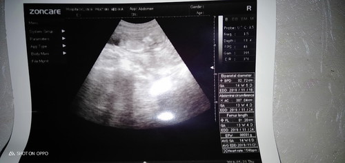 aku usg tgl 25 -5-2019 kemarin bun 14w 5d