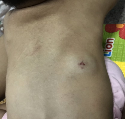 น้องมีลักษณะเหมือนปานแดงและขึ้นในถุงนำ้ที่หลังอ่ะคะ