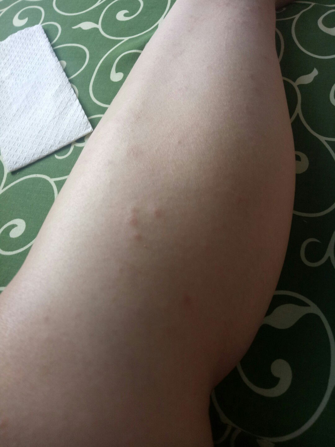 Gatal gatal seluruh badan