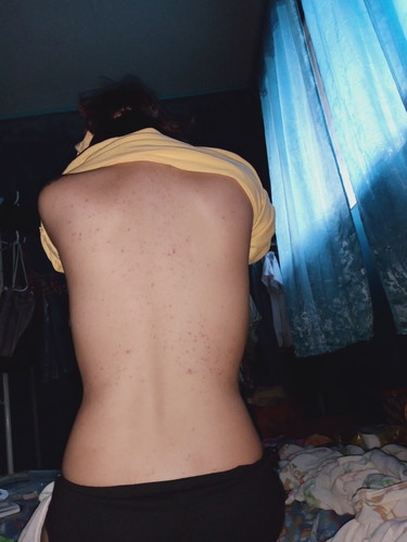 acne
