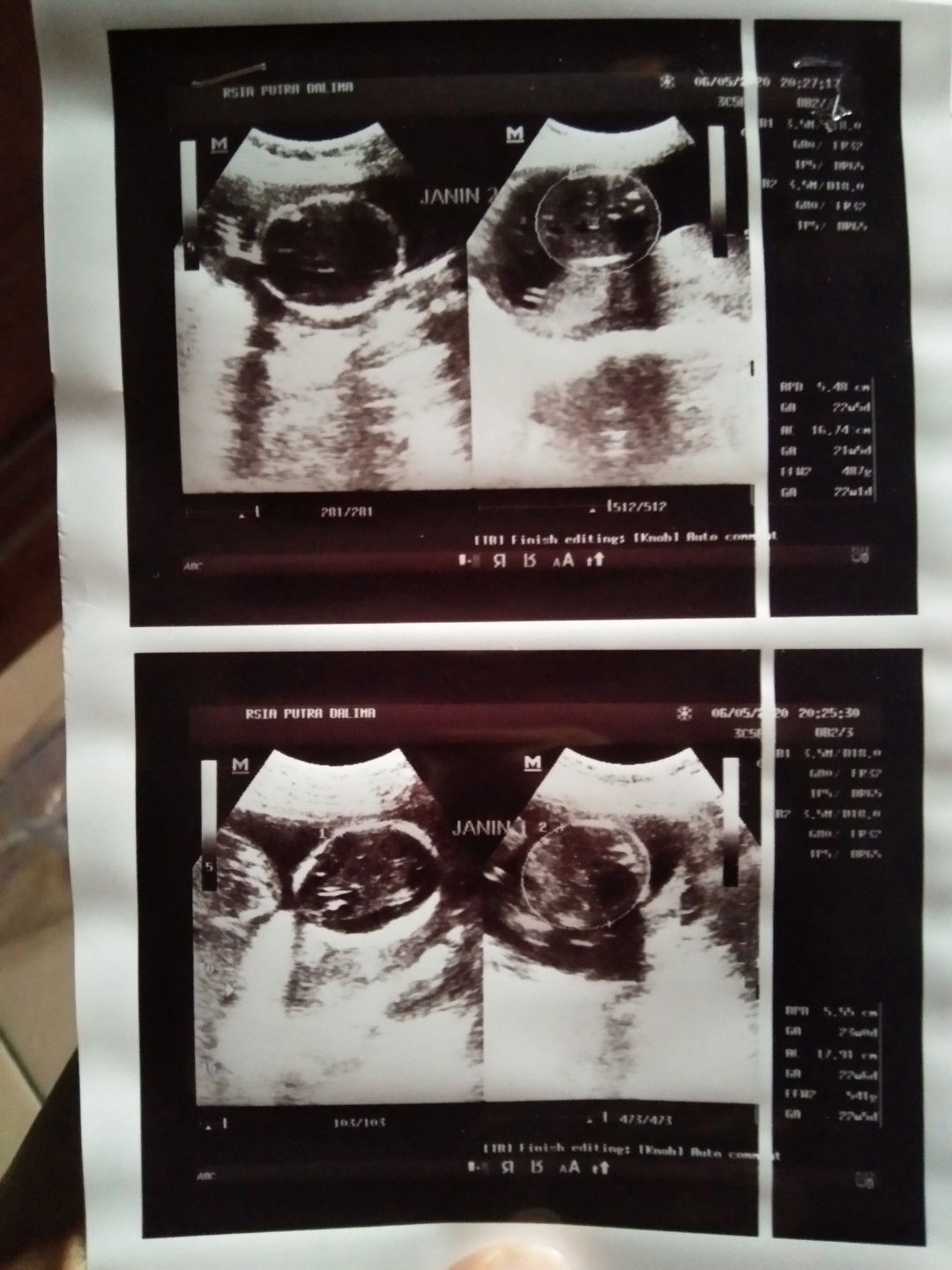 kalo hamil anak kembar lahir nya lebih awal dari hamil biasa nya ??