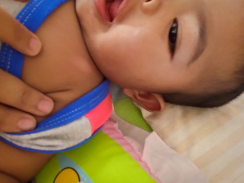 คล้ายเกลื้อน
