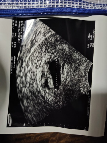 ถุงตั้งครรภ์ต่ำลง