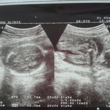 สอบถามผู้รู้หน่อยค่ะ มีใครดูออกมั้ยค่ะว่าตรงไหนเป็นส่วนหัวหรือตัว และตรงไหนเพศเด็ก