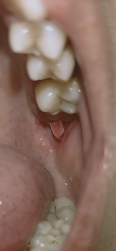 Gums issue