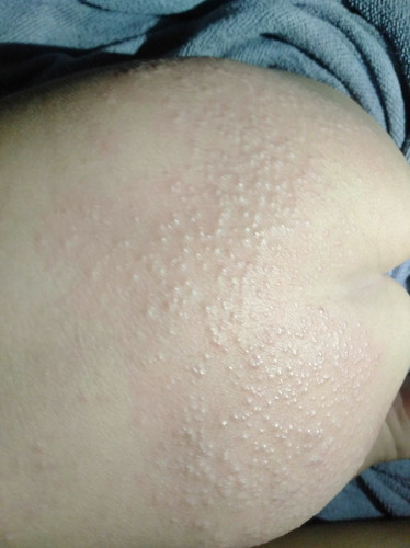 น้องเป็นผื่นที่ก้น ต้องทายาอะไรถึงหายคะ