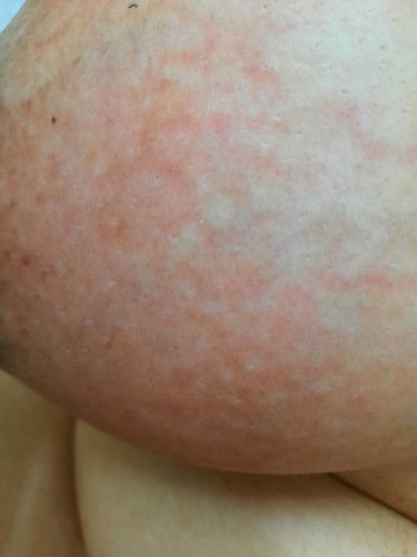 My breast are always red. But does not hurt.