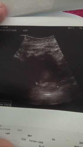 fabroid ketika hamil