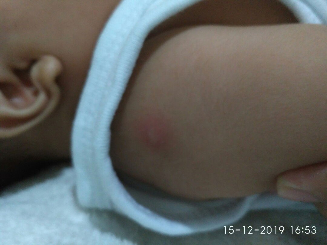 bekas suntikan BCG bengkak