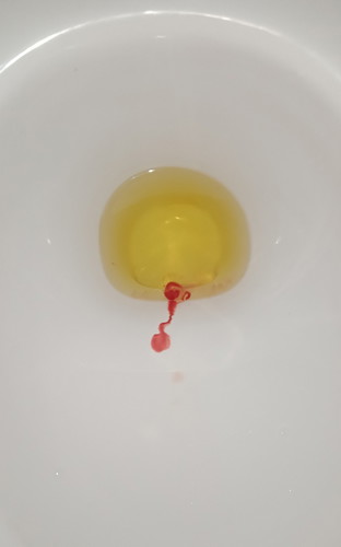 urine blood???