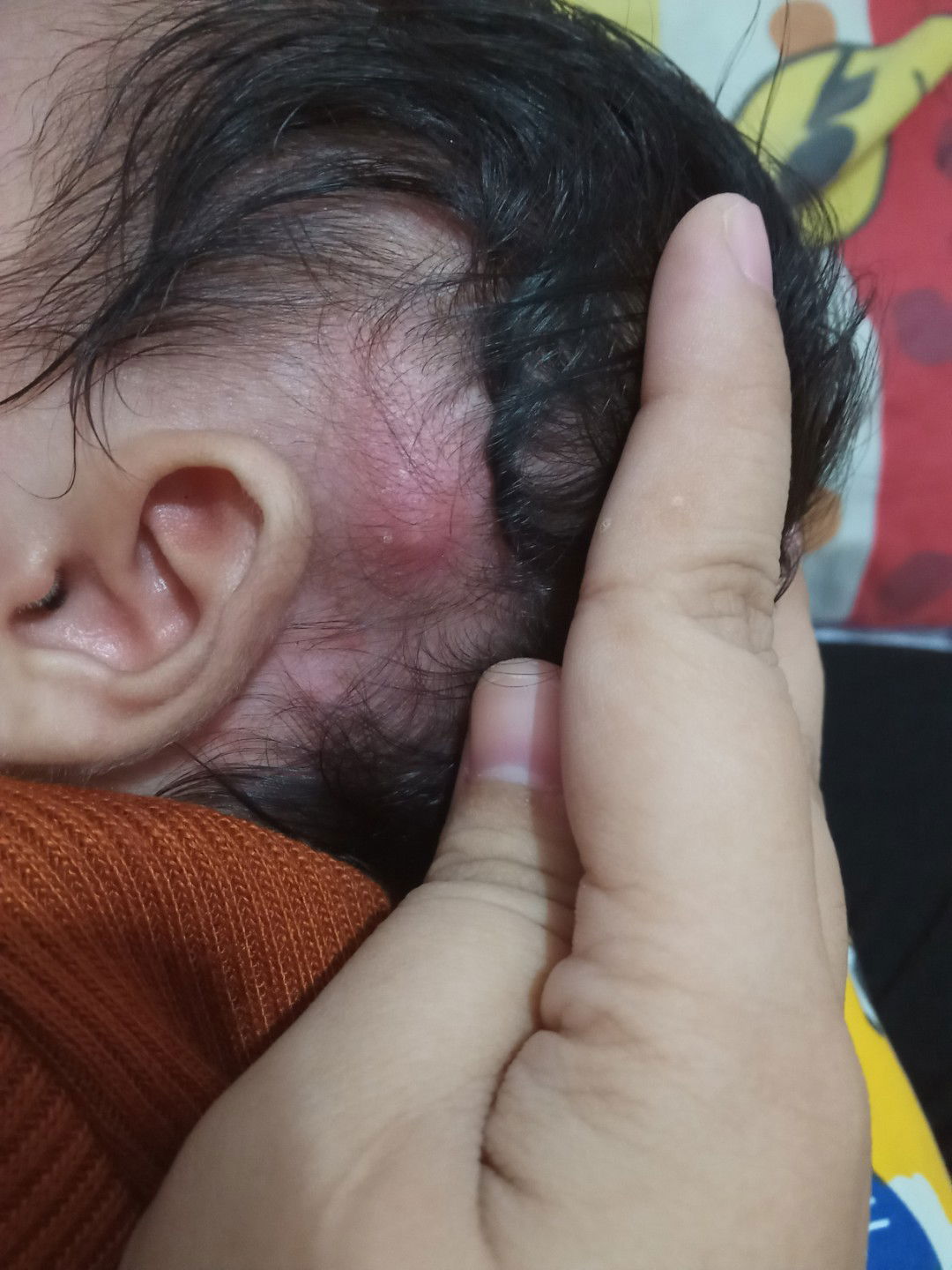 kaya bisul tapi ga ada mata nya