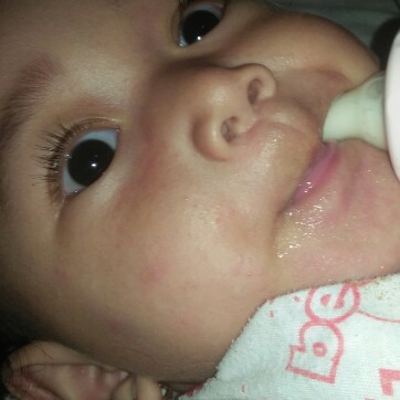 ruam pipi